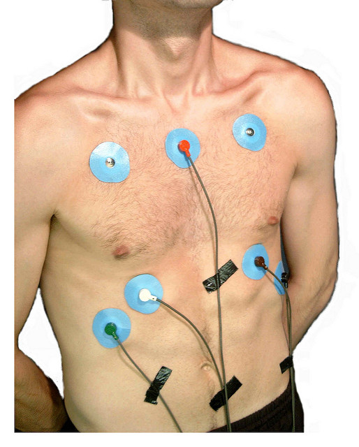Holter monitoring can detect Ectopic Beats and Arrhythmia