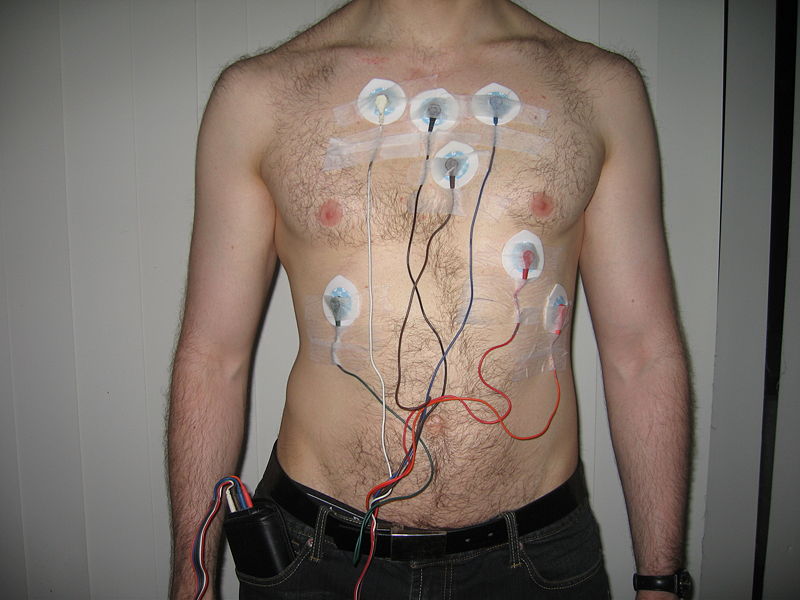 ECG monitoring for Palpitations and Arrhythmia