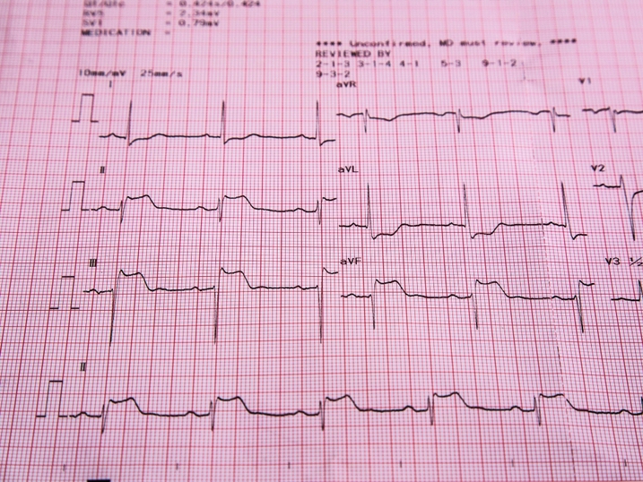An Electrocardiogram can tell us about your cardiac rhythm and detect cardiac ischaemia
