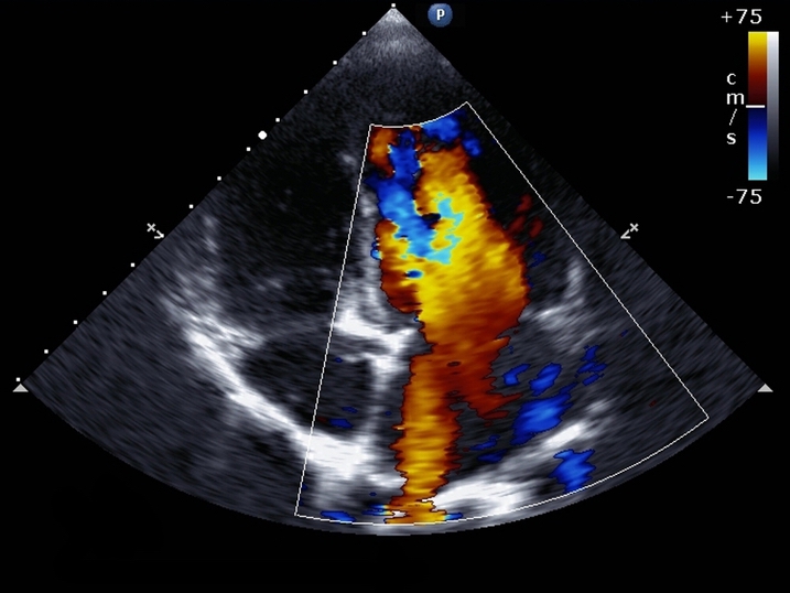 Can Echocardiogram can directly assess your heart valves
