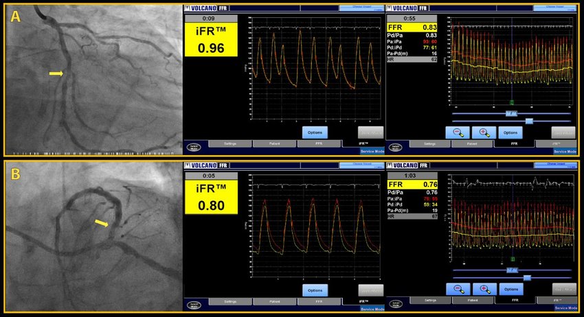 Coronary physiology pressure wire assessment — Dr Nijjer, London