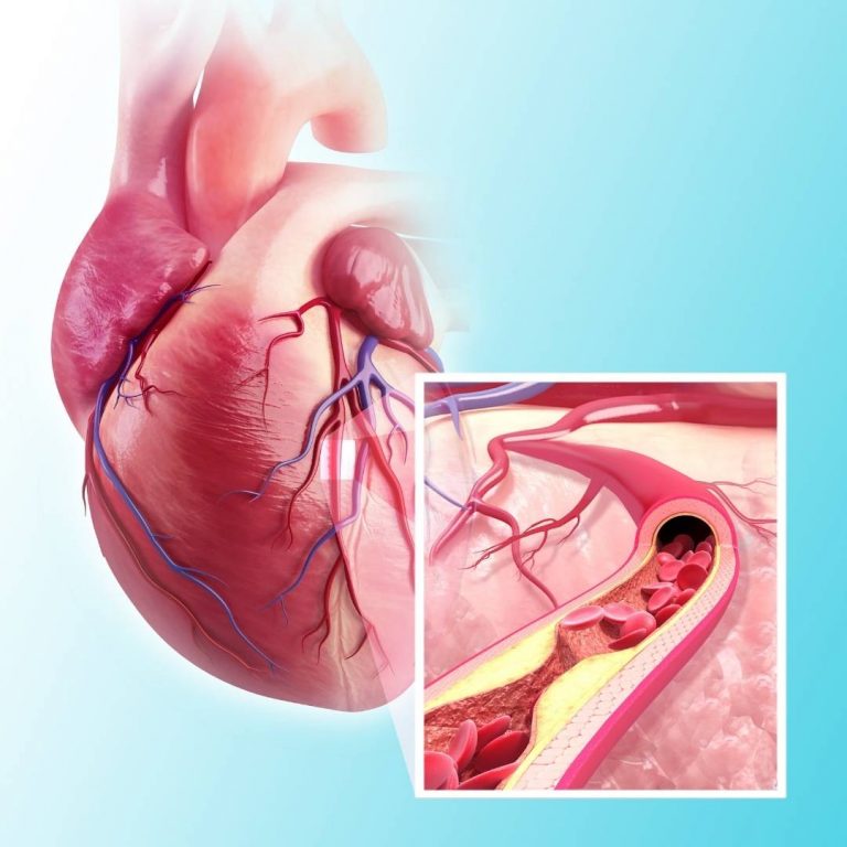 Coronary Heart Disease is caused by atherosclerosis developing in the coronary arteries