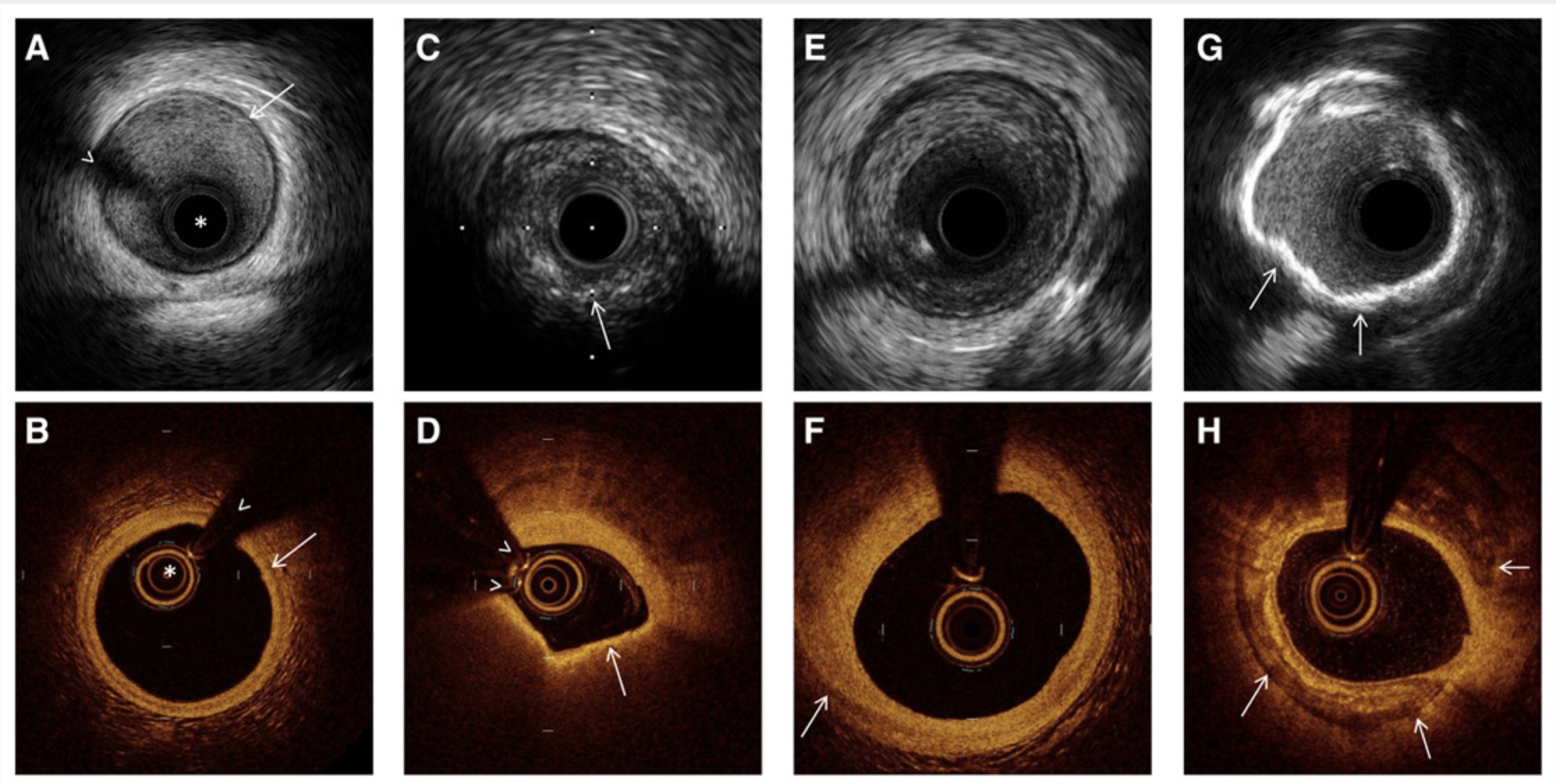 Intracoronary imaging OCT catheter coronary artery — Dr Nijjer London