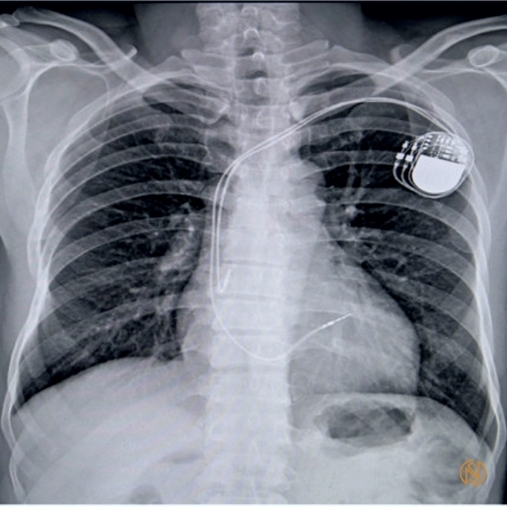 Cardiac Pacemakers Explained | Expert Cardiologist